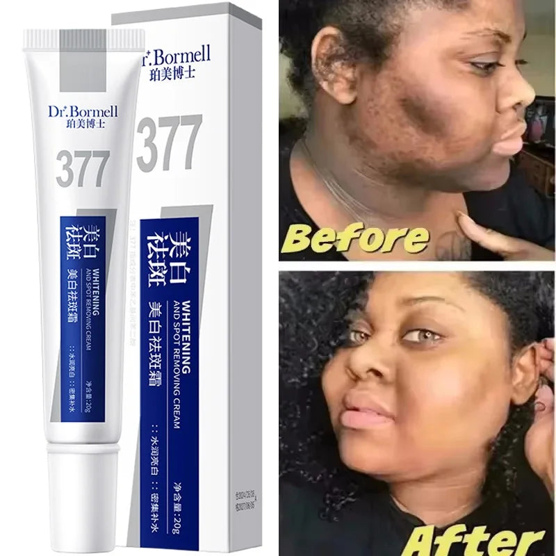Powerful Spot-Removing Whiten Cream Brighten Skin Fast Eliminates Melanin Pigmentation Melasma Dark Spots Korean Face Skin Care