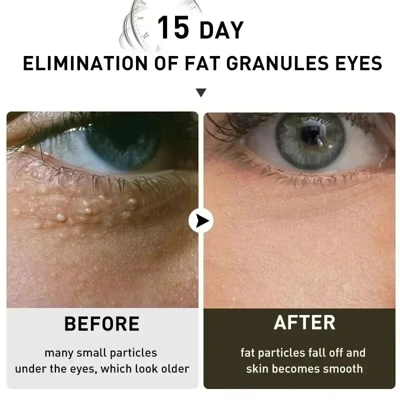 Hoygi Eye Fat Granules Removal Eyestick Anti-Puffiness Firming Cream Anti Inflammatory Fade Fine Line Repair Skin Barrier Skin Care