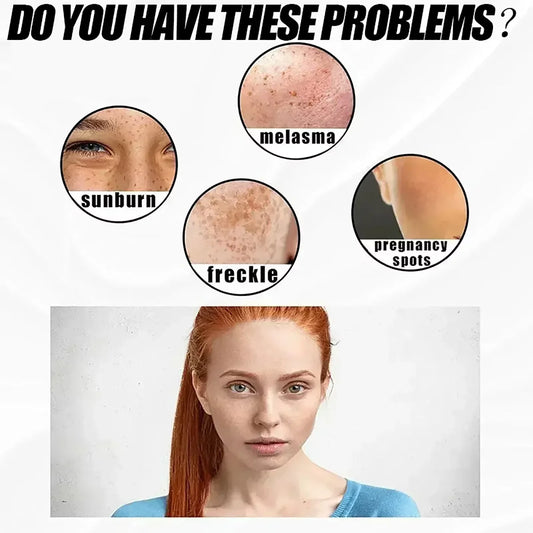 eelhoe Niacinamide Melasma Brightening Cream Reduce Melanin Brighten Cream Lighten Dark Skin Chloasma Serum Fade Fine Face Lines