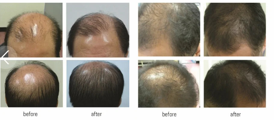 CE Approved Kernel KN-8000B Red Light Therapy Laser Hair Growth Cap Helmet For Hair Restoration