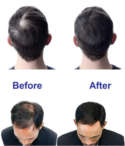 CE Approved Kernel KN-8000B Red Light Therapy Laser Hair Growth Cap Helmet For Hair Restoration