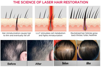Hair Growth Cap Anti Hair Loss Hair Growth Laser Helmet Hat Hair Regrowth Light Therapy Device Hair Growth Treatment Hat Machine